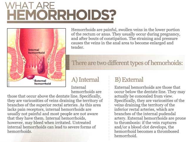 what is hemorrhoids